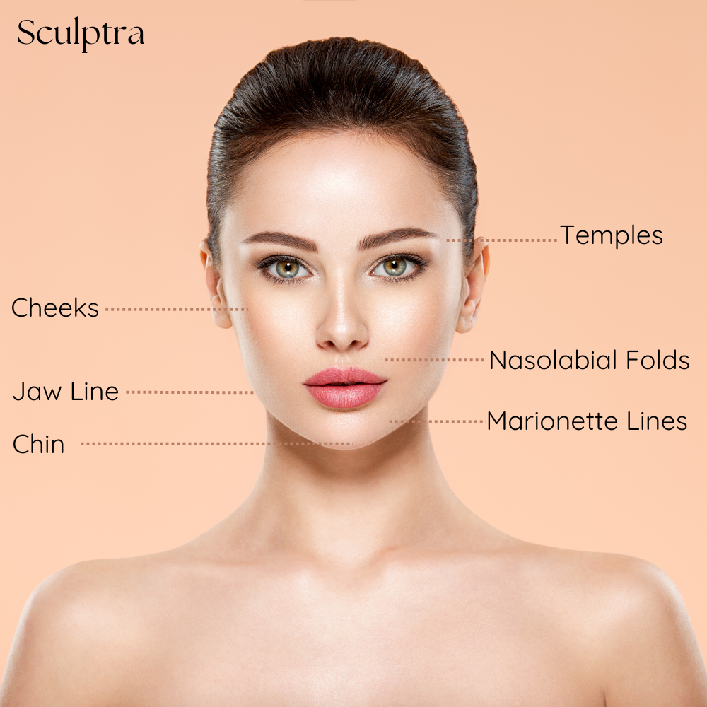 sculptra_areas